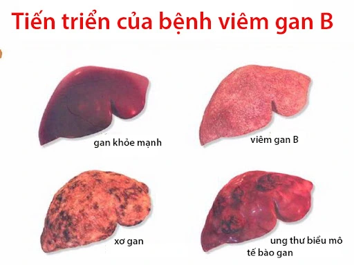 Tien-trien-cua-benh-vien-gan-b.webp